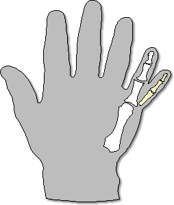 polydactyly