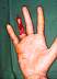 Ringavulsion2.jpg